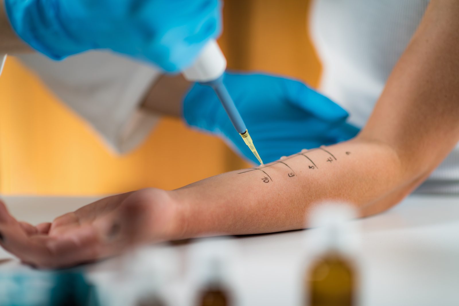 Allergy skin testing